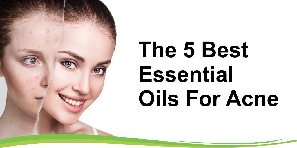 the 5 best essential oils for acne header