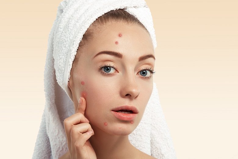 young woman with acne breakout