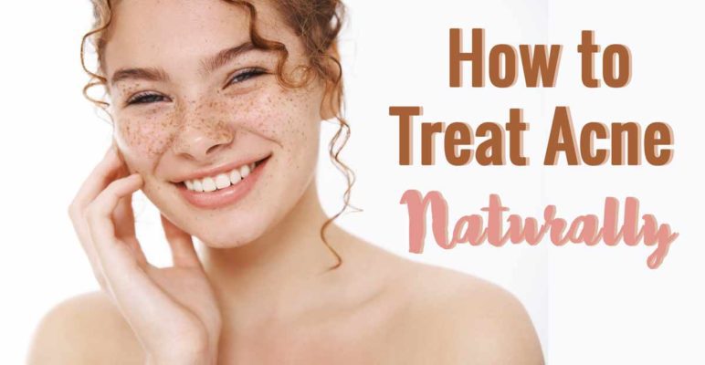 how to treat acne naturally
