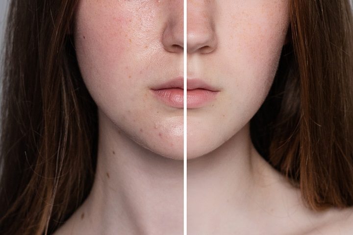 girl with before and after acne treatment